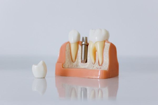 Implantes Dentários